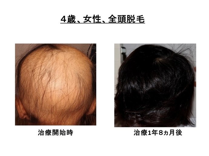 円形脱毛症　病院